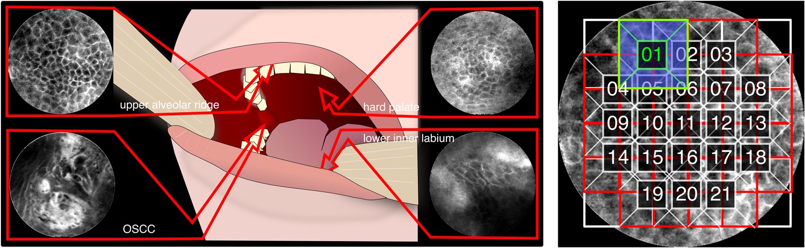 oral cancer detection ai